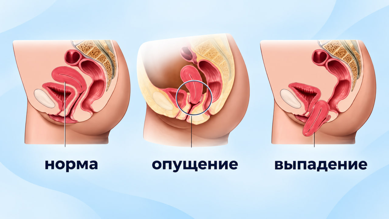 Опущение органов малого таза