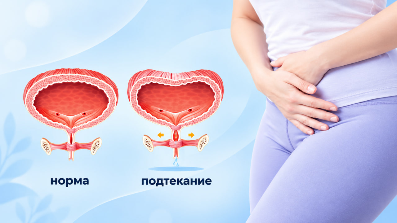 Недержание при смехе и кашле